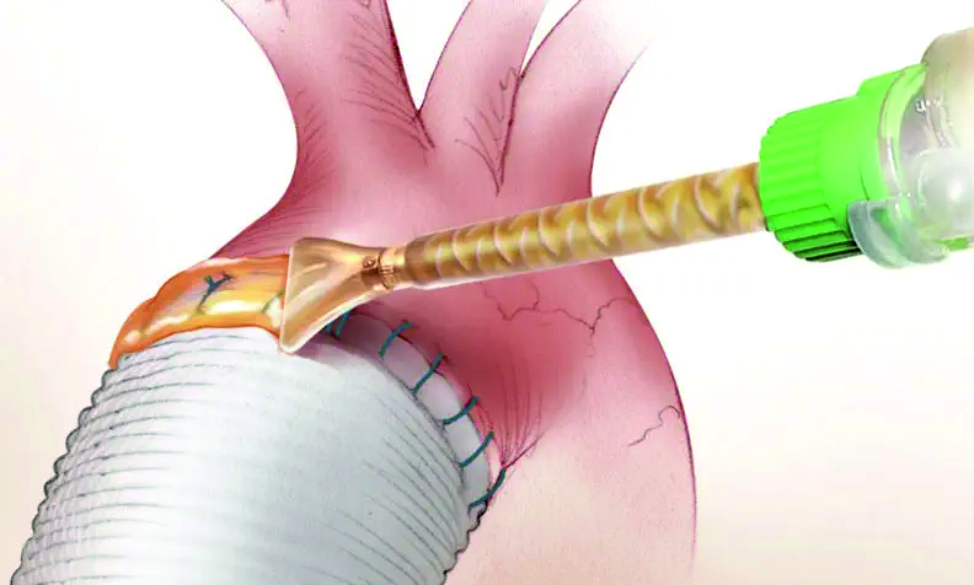 Новинка! Аппликаторы для BioGlue